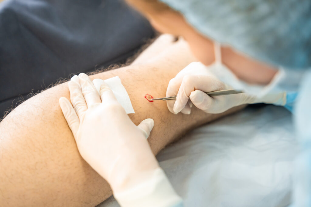 Dermatologist surgeon removes skin diseases with scalpel, operation process. High quality photo