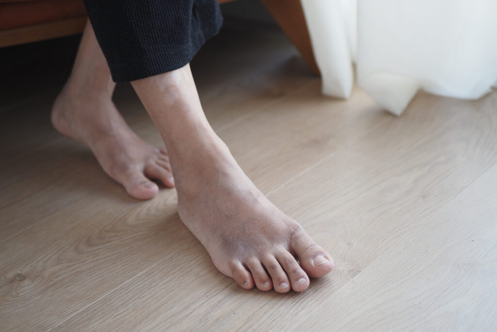 close up of women feet with swelling